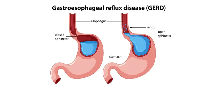 Gerdstop (pantoprazole + domperidone) reflux capsule — PPI for GERD, domperidone safety FDA, informational only