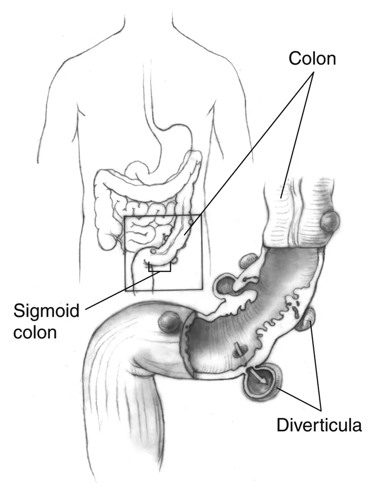 Illustration: diverticula in the sigmoid colon